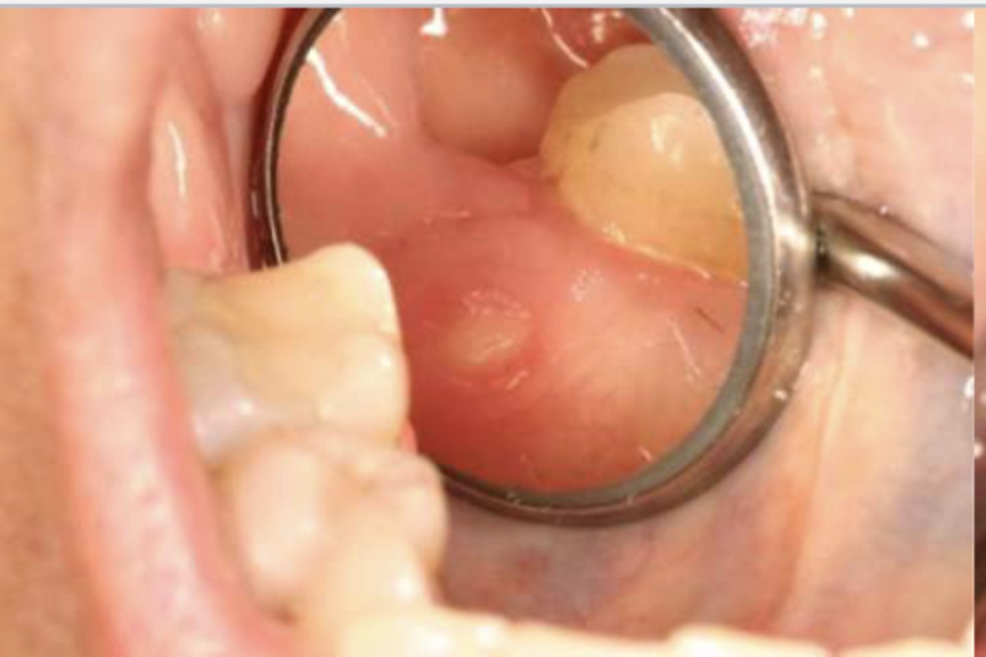 <p>Upon clinical examination, you find a lesion that appears to be necrotic bone showing through the lingual attached gingiva of #31. What do you suspect? Is there anything you should look for in the patient history?</p>