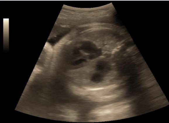 <p>a) diaphragmatic hernia</p><p>b) normal thoracic activity</p><p>c) cardiomegaly</p><p>d) cognenital cystic adenomatoid malformation</p>