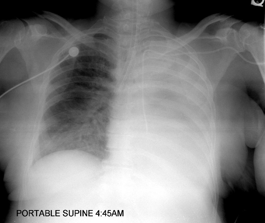 <p>Perforation, thrombosis, catheter dysfunction, and cranial injection.</p>