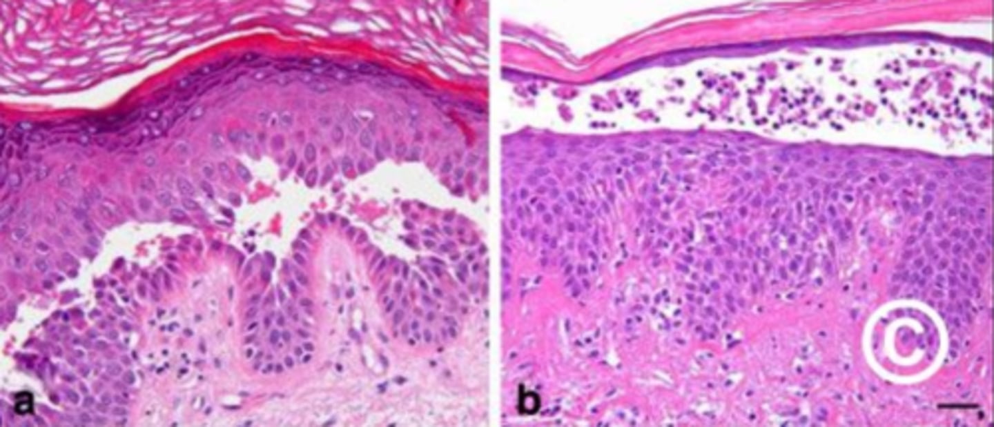<p>Which pemphigus is which?</p>