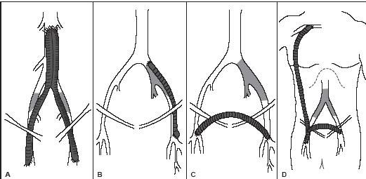 <p>Recall that the inguinal canal is the point at which the iliac artery becomes the common femoral.</p><p>Name the bypass grafts. </p>