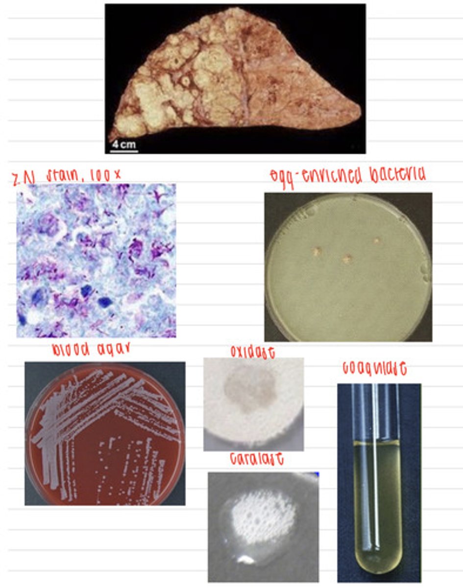 <p>a man dies and at the necropsy we find granulomas on his lungs. we take samples and inoculate onto non enriched media (no growth), blood agar, macconkey agar (no growth), and finally, egg enriched media. we stain the colonies with the ZN stain and perform coagulase, catalase, and oxidase tests. here are the results.</p><p>what is the diagnosis?</p>