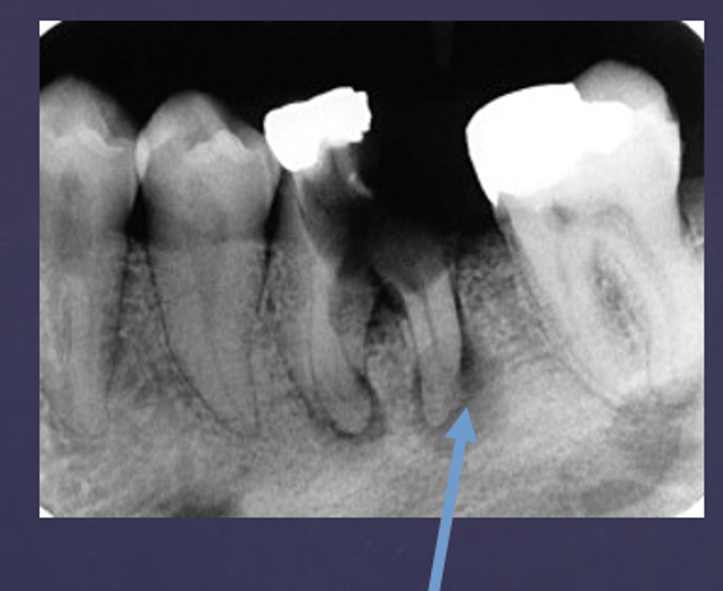 <p>Is this radiolucent inflammation classified as rarefying or sclerosing?</p>