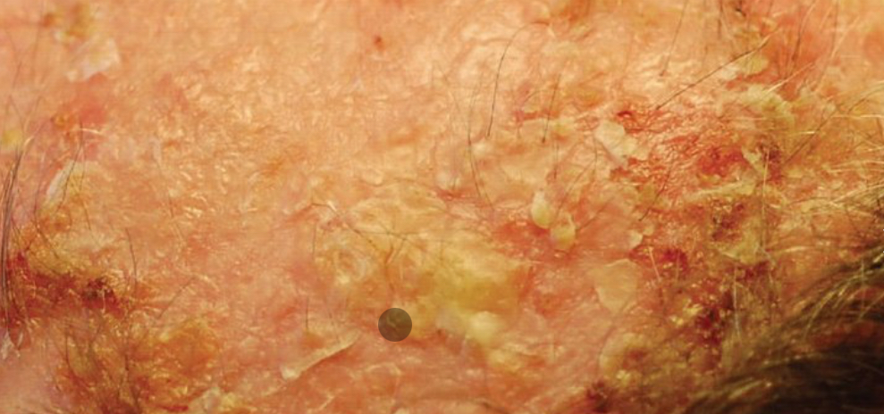 <p>Thick papule or plaques with rough, surface </p><p>Occurs on sun-exposure area of skin </p>