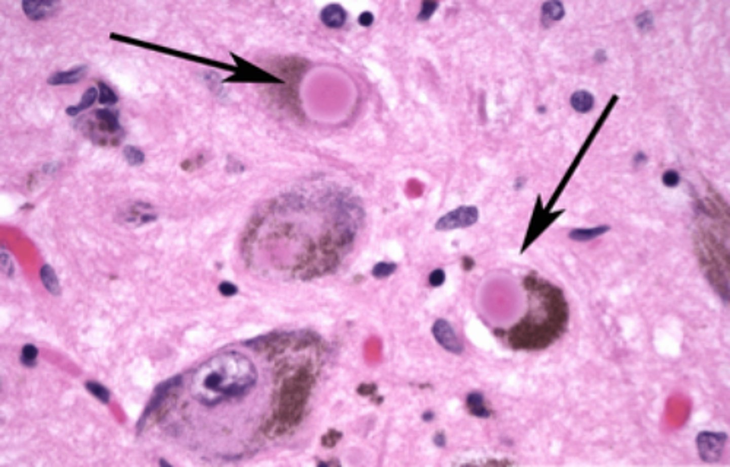 <p>Define Lewy Bodies</p>