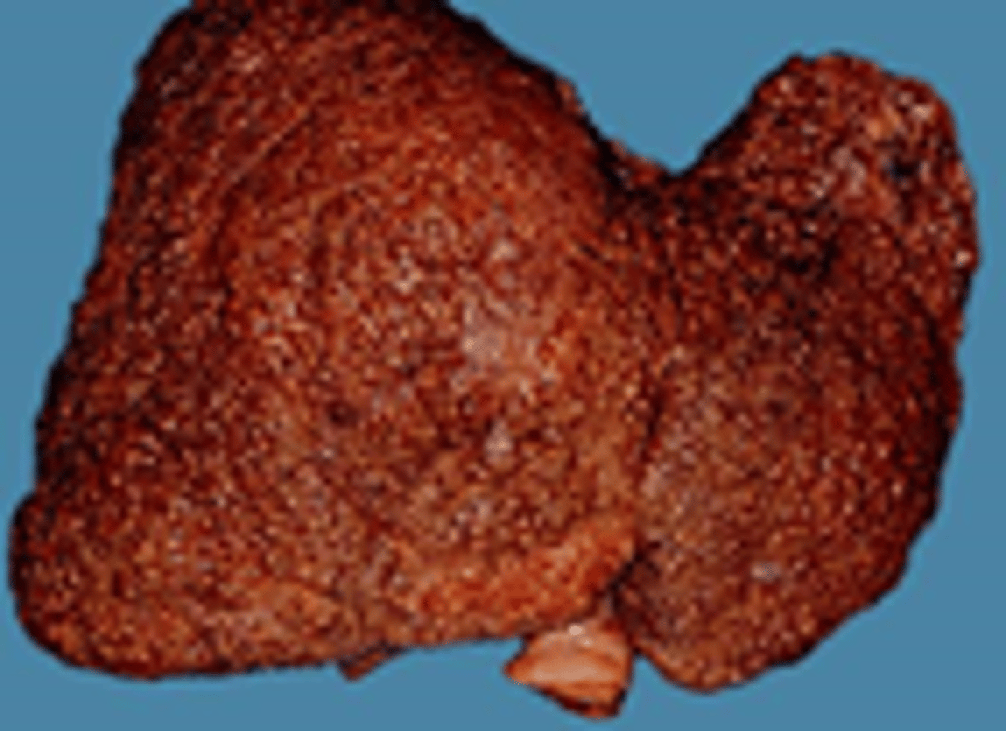 <p>Transformation into decompensated cirrhosis (encephalopathy -> increased confusion -> cerebral edema -> death)</p>