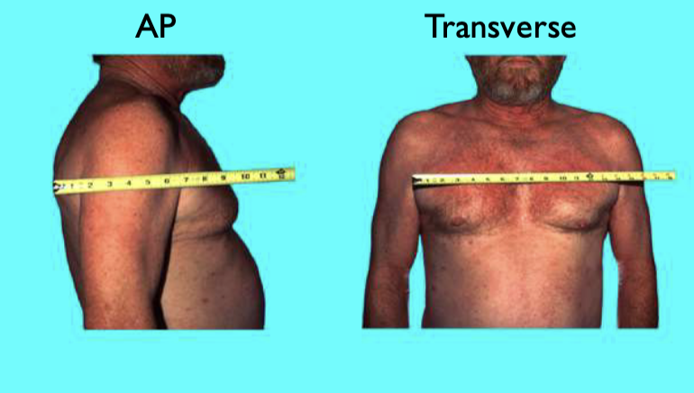 <p>AP: Transverse Ratio </p><ul><li><p>normal anteroposterior:transverse ration = 1:2</p></li><li><p>Costal angle should be around 90 degrees </p></li></ul><p></p>
