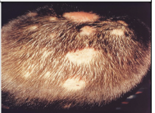 <p>Fungal infection of the skin (ringworm); severe itching and burning with red, scaly lesions. \n • Tinea capitis (head) \n • Tinea corporis (body) \n • Tinea cruris (groin) –“jock itch” \n • Tinea pedis (feet)</p>