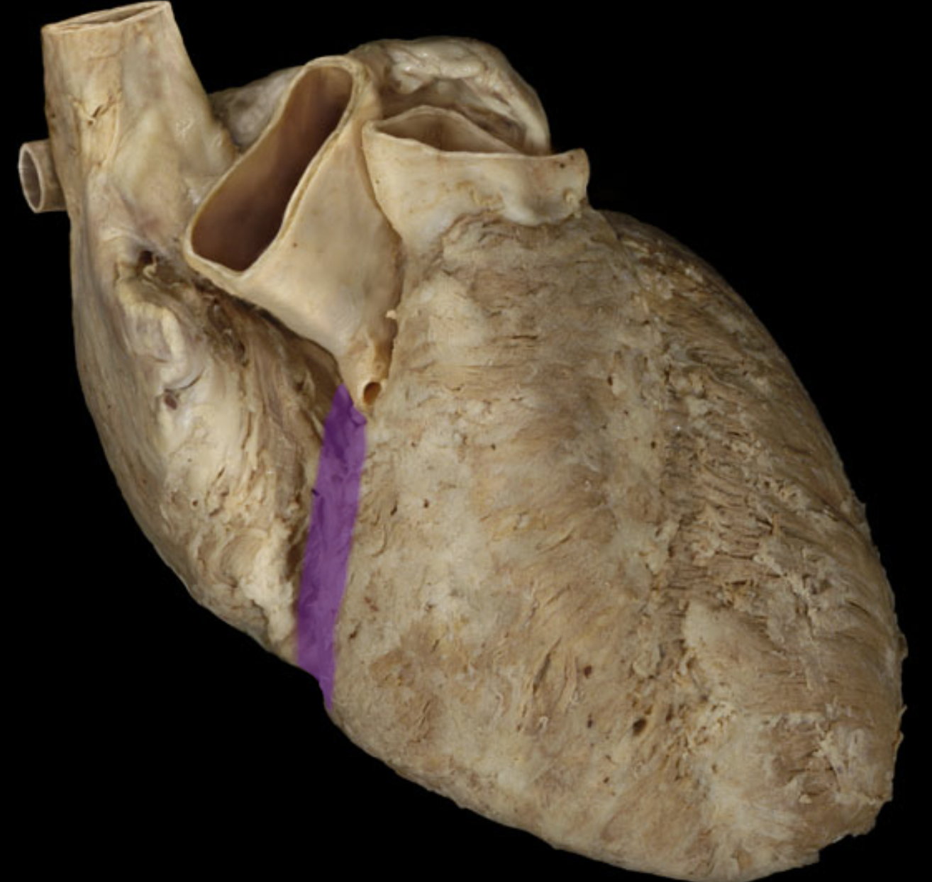 <p>Coronary sulcus</p>