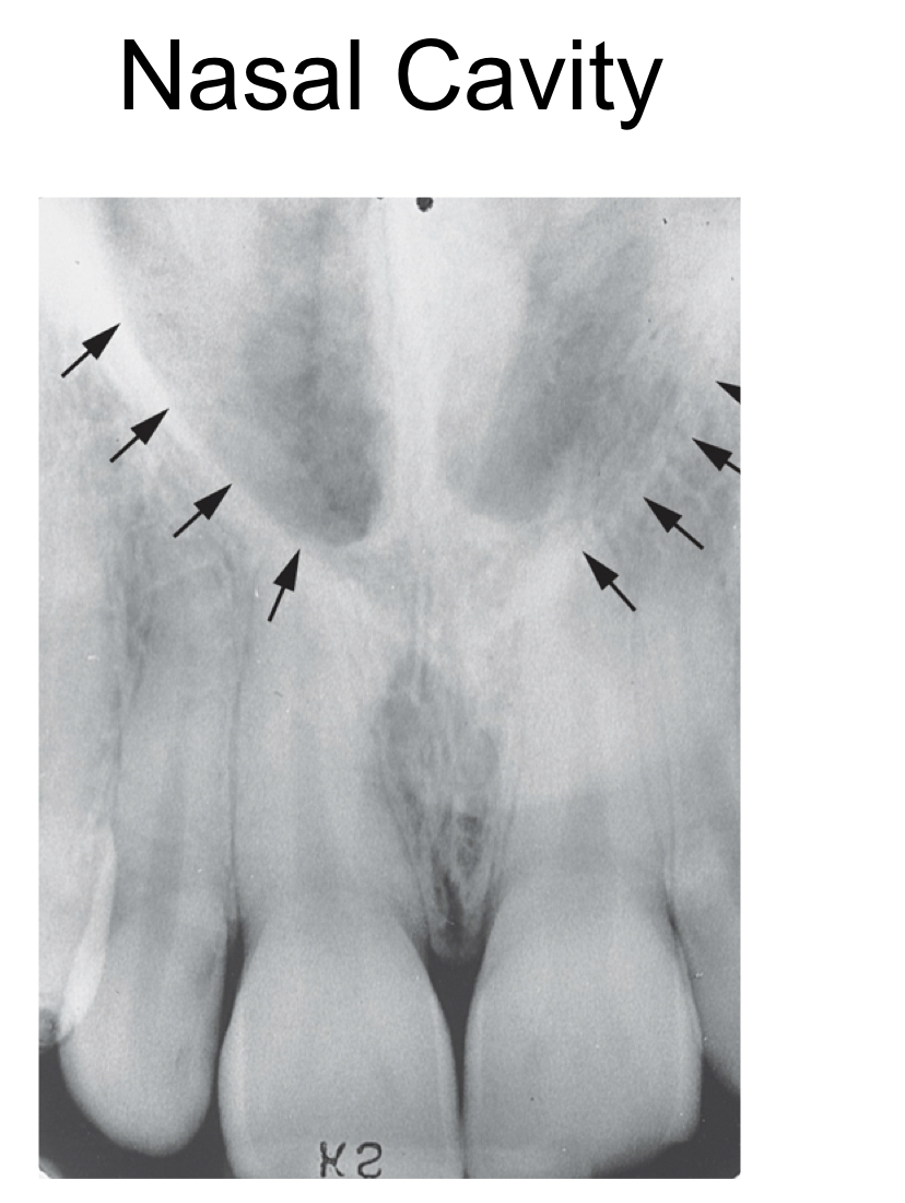 * pear shaped compartment of bone located superior to maxilla
* radiolucent
