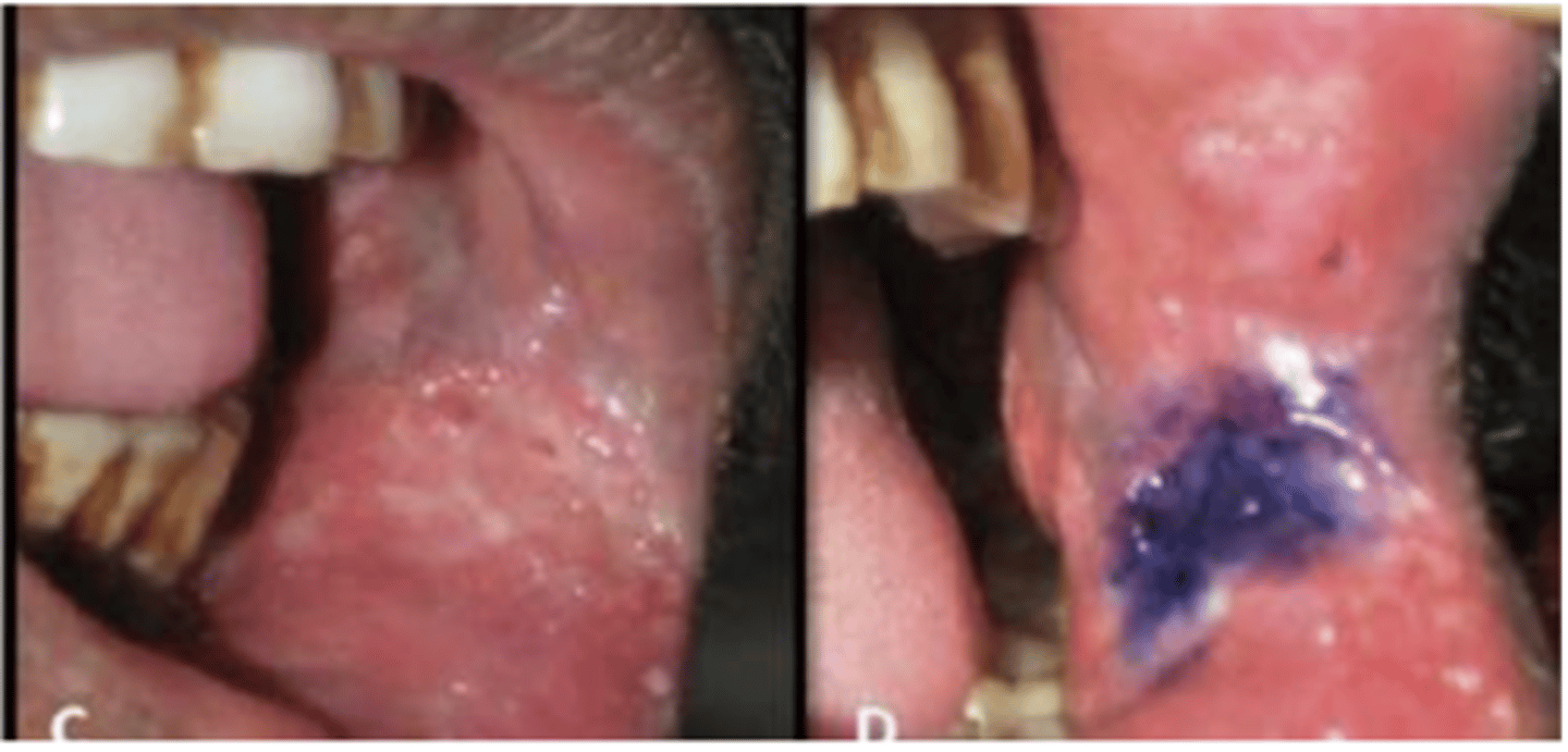 <p>oSimple, inexpensive</p><p>For identiying early oral squamous cell carcinoma and high grade dysplasias</p><p>o How to use</p><p>Rinse mouth with:</p><p>• 1% aceNc acid for 20s</p><p>• Plain water for 20s</p><p>• 1% toluidine blue for 60s</p><p>• 1% aceNc acid for 20s</p><p>• Plain water for 20s</p><p>o Detecting changes:</p><p>= Dark blue lesions</p>