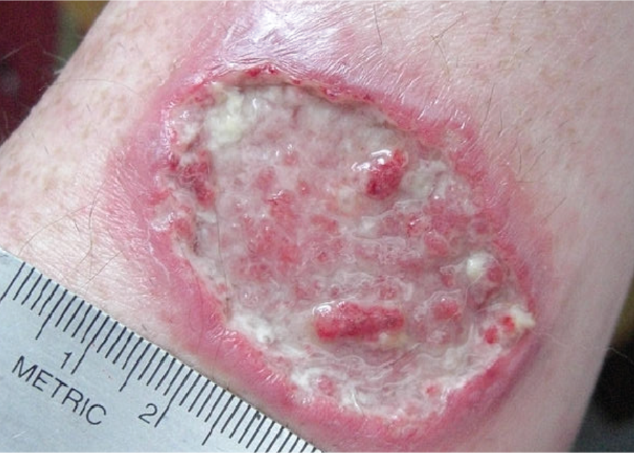 <p><span>Skin lesion with loss of epidermis and dermis (deeper than erosion)</span></p>