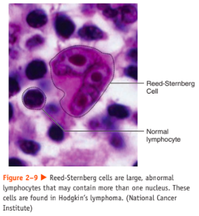 <ul><li><p>a cancer of the immune system</p></li><li><p>most frequently diagnosed between the ages of 15 and  40 and after 55</p></li><li><p>marked by the presence of a type of cell called the Reed-Sternberg cell</p></li><li><p>includes a wide variety of diverse subtypes, each of which may have a distinct treatment and prognosis.</p></li><li><p>Risk factors include:</p><ul><li><p>certain viral infections (Epstein-Barr and HIV),</p></li><li><p>a weakened immune system,</p></li><li><p>and a family history of Hodgkin’s lymphoma.</p></li></ul></li><li><p>Signs and symptoms include:</p><ul><li><p>painless swelling of lymph nodes (neck, armpit, or groin),</p></li><li><p>fatigue,</p></li><li><p>unexplained fever,</p></li><li><p>soaking night sweats,</p></li><li><p>itchy skin,</p></li><li><p>coughing,</p></li><li><p>trouble breathing,</p></li><li><p>chest pain</p></li><li><p>unexplained weight loss</p></li></ul></li><li><p>etiology is idiopathic</p></li></ul>