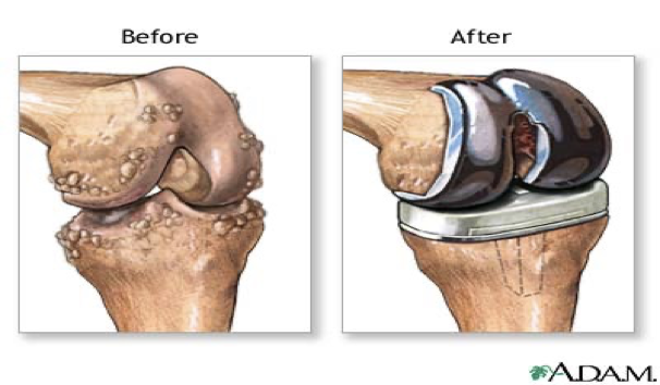 <p>knee prosthesis - before</p>