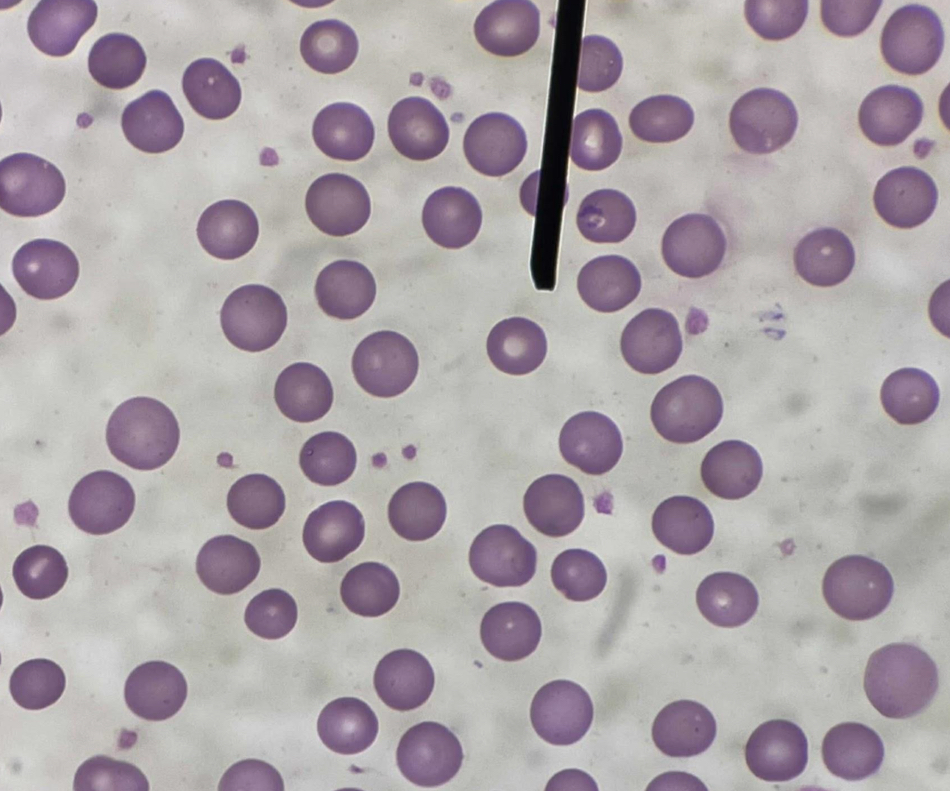 <p>A. Identify the pointed cell</p><p>B. Describe the striking feature</p><p>C. What characteristic shape of the cell is responsible for its deformability and flexibility ?</p><p>D. Other term for this cell?</p>