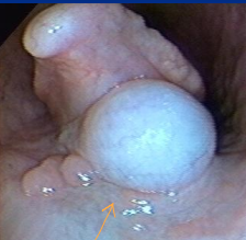 <ul><li><p><strong>Cleft palate:</strong> <u>milk in nostrils</u> from birth; <u>aspiration pneumonia</u>; Dt w/ endoscopy; Tx w/ <u>Sx</u></p></li><li><p><strong>Pharyngeal cysts:<u> </u></strong><u>congenital; obstructive noise/choke;</u> Tx w/ <u>Sx removal&nbsp;</u></p></li><li><p><strong>Hypoplastic/flaccid epiglottis: </strong>congenital or neuropathic;<u> recurrent DDSP, resp nosise, epiglottis entrapment</u>; Tx w/ epiglottic augmentation via <u>Teflon injection</u></p></li><li><p><strong>4th branchial arch defect</strong>: <u>rare</u>; resp noise, <u>poor performance, </u>cough, aspiration; Dt: <u>“rostral displacement of palatopharyngeal arch</u>”; No Tx</p></li></ul><img src="https://knowt-user-attachments.s3.amazonaws.com/3bf2e2e8-82d0-4948-8b88-af5ba806f267.png" data-width="50%" data-align="center"><p></p>