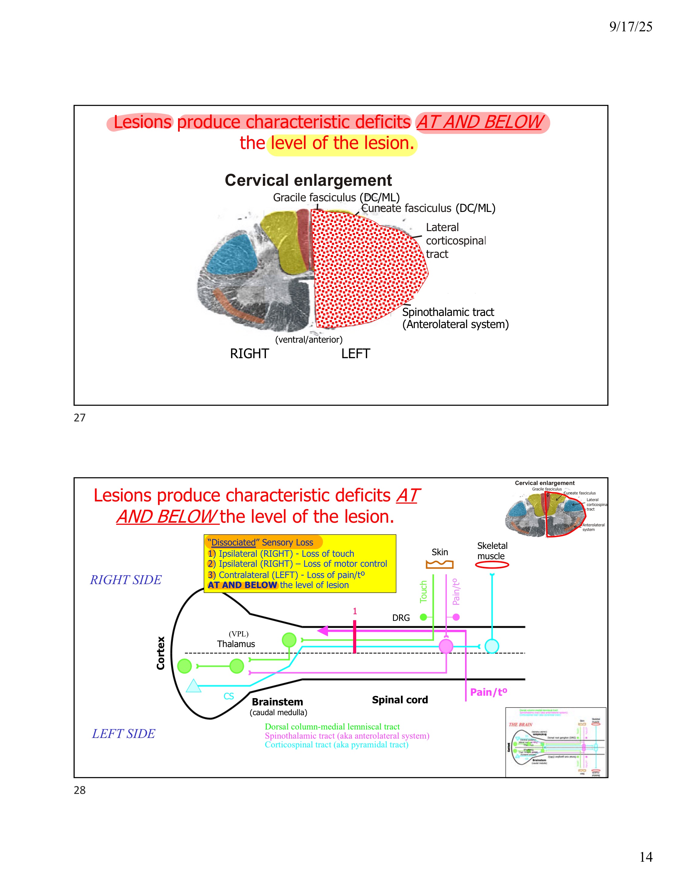 <p>Characteristic deficits <strong>AT AND BELOW</strong> the level of the lesion</p>