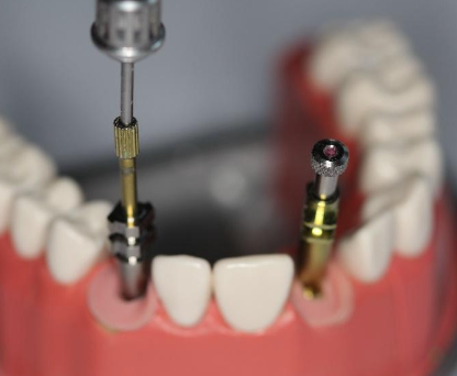 <p>How do you connect the impression coping?</p>