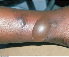 <p>lesions with diameter greater than __cm</p>