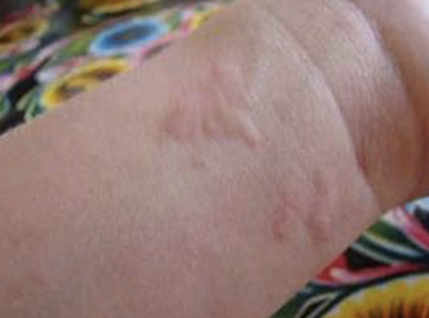 <p>Compressible, raised edema that is typically itchy-- hives</p>