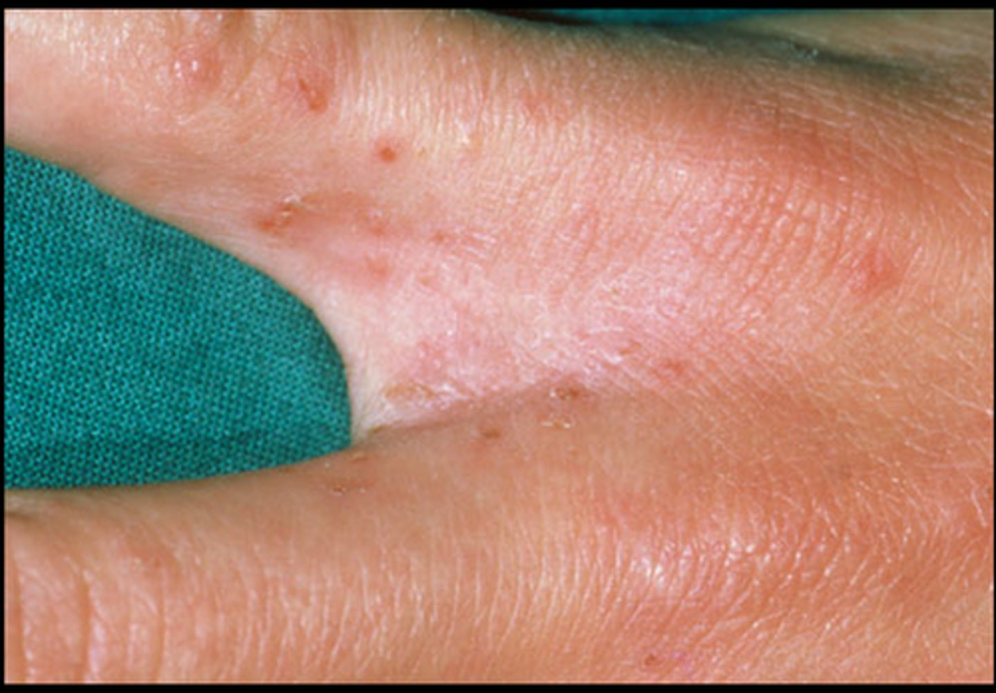 <p>Web spaces of fingers/toes, palms, and soles (intensely pruritic at night)</p>