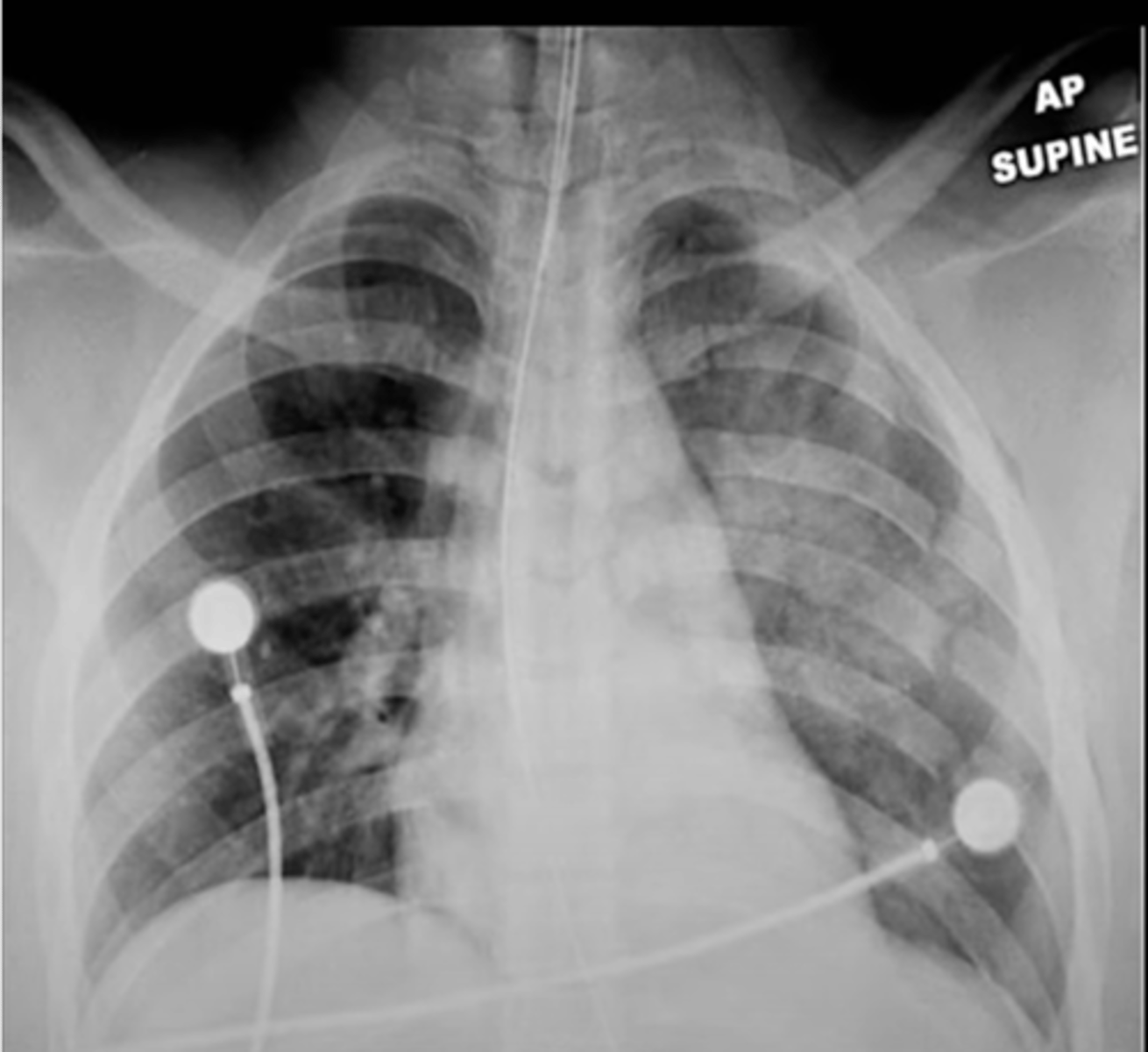<p>-are there fractures</p><p>-scoliosis and kyphosis</p><p>-soft tissue emphysema</p><p>-barrel chest</p>