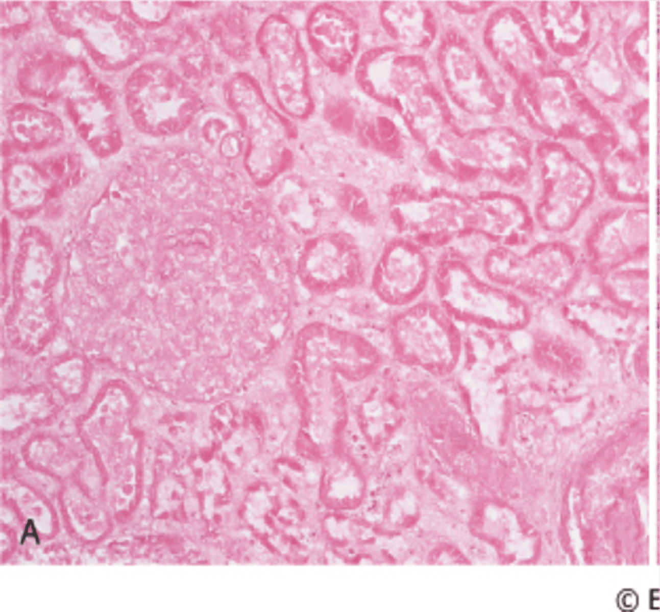 <p>Dry necrosis, Cells keep their outline but lose nuclei (Ex: Hypoxic cell death)</p>