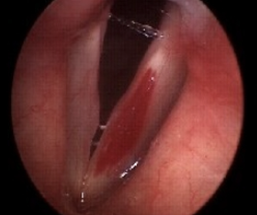 <p>ruptured blood vessels <strong>in </strong>the submucosal layer of vocal folds (superficial lamina propria). often due to an acute event and increased risk if on blood thinners</p>