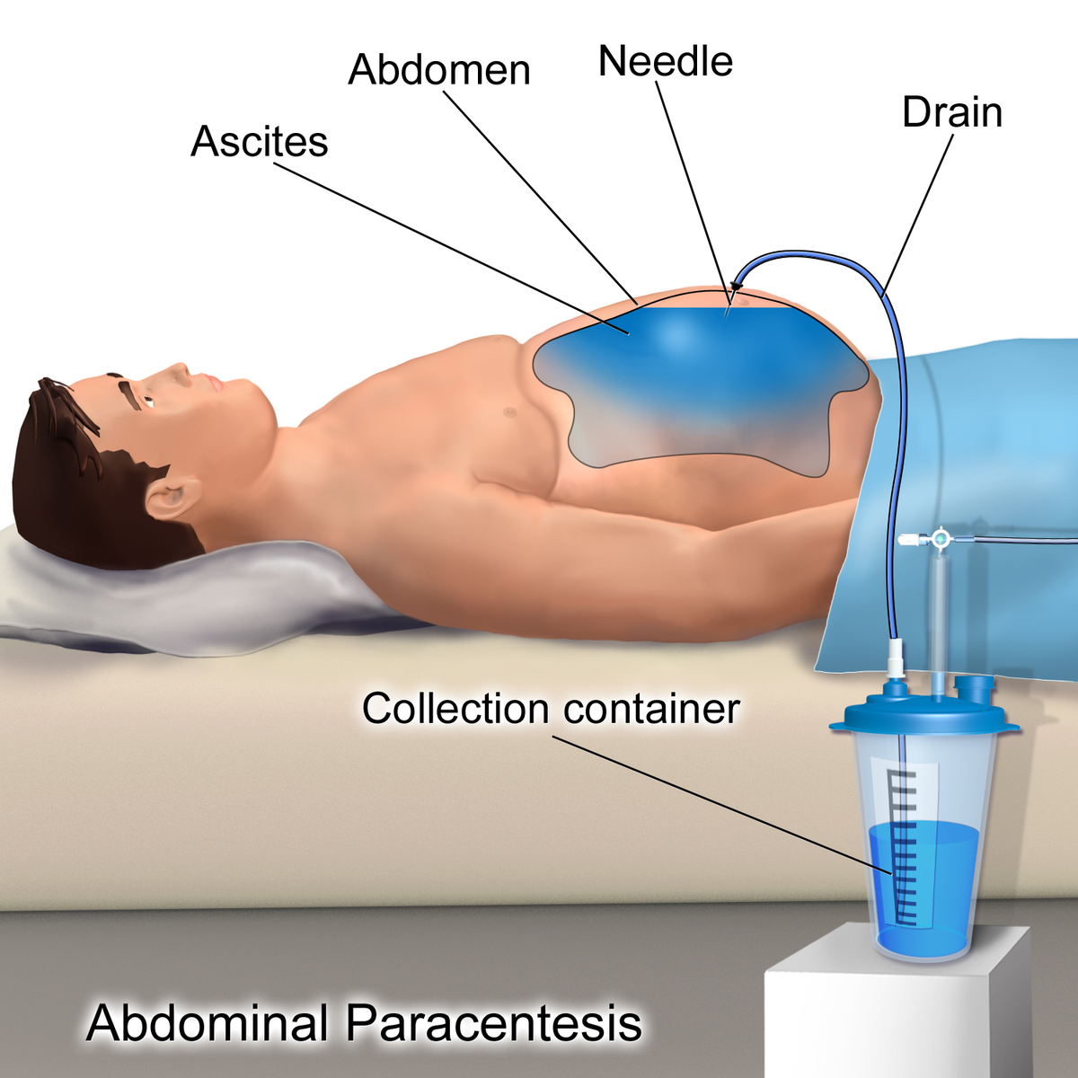 <p>- Is the removal and analysis of fluid from a <strong><em>body cavity</em></strong>. <br>- In abdominal paracentesis fluid is removed from the abdominal cavity.</p>