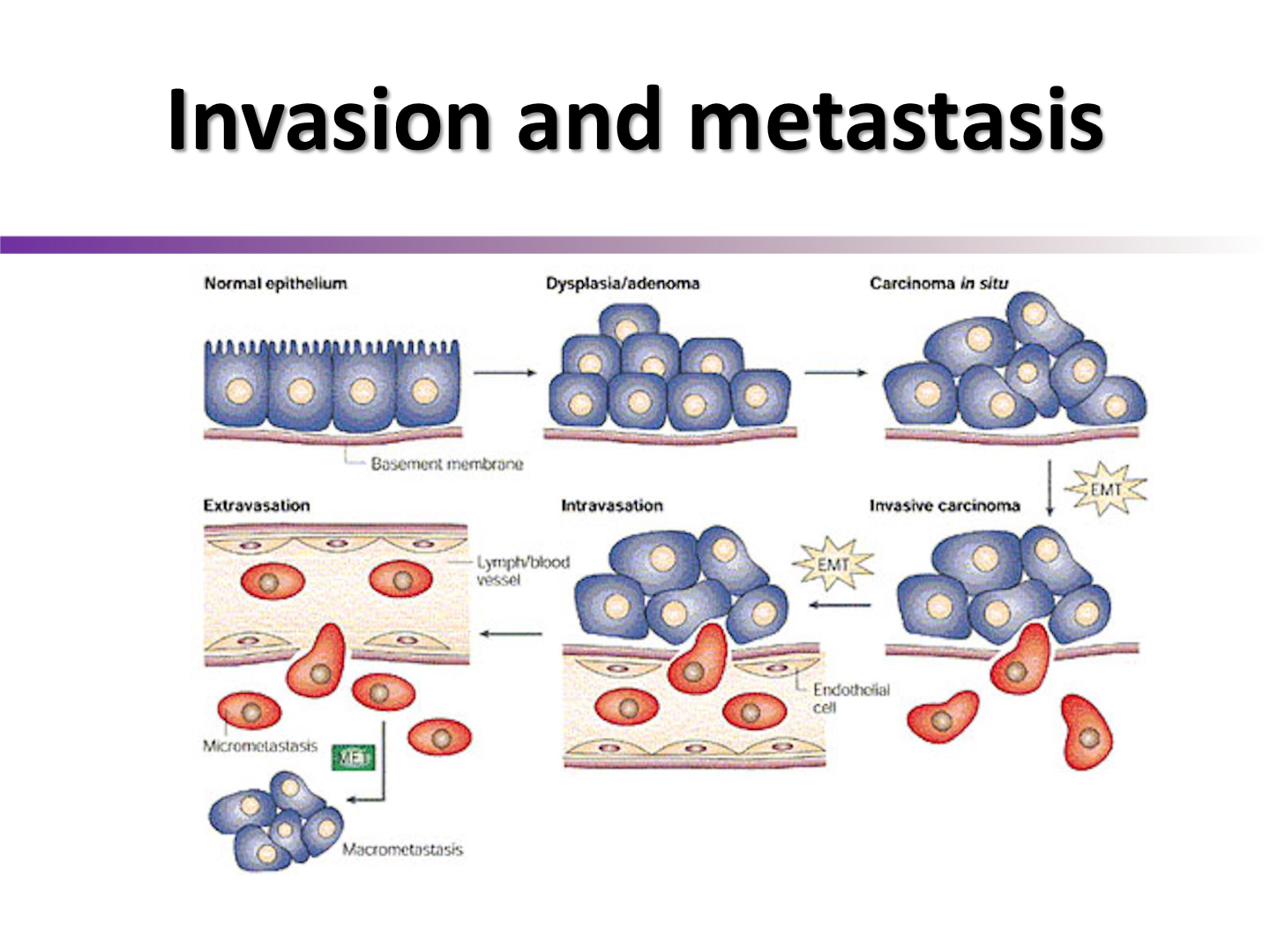 <p>polar epithelial cells lose polarity and connection to eachother to go into lymph and blood vessels to spread</p>