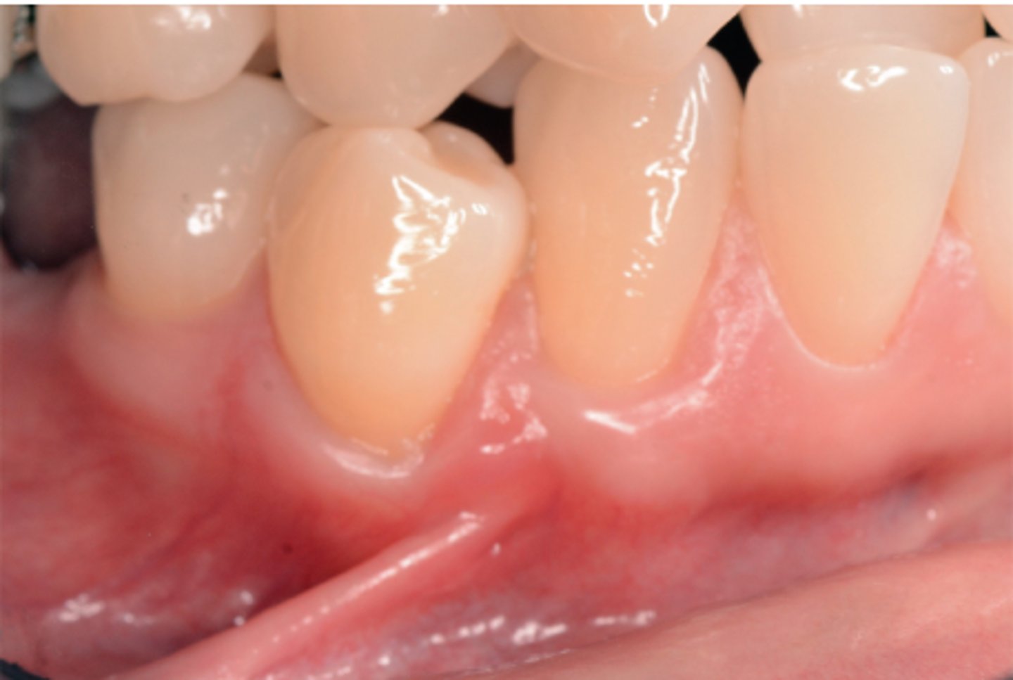 <p>Describe the tissue type:</p><p>• a_______ f______</p><p>• d______ v______ d_____</p><p>• n_____ z_____ o_ k______ t_____</p><p>• likely s____ biotype: more likely disease with frenum because of thin attachment</p>