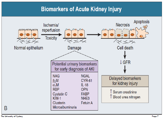 <ul><li><p>Abrupt decline in renal function leading to an increase in serum concentrations of urea, creatinine &amp; other substances (occurs over a period of days)</p></li><li><p>Common - occurs in 2% to 7% of all hospital admissions</p><ul><li><p>and in up to 36% to 67% of critically ill patients</p></li><li><p>very common amongst the elderly</p></li></ul></li><li><p>may occur in someone either with previously normal renal function or as an acute and unanticipated deterioration in function in a patient with previously established chronic kidney disease (“acute on chronic”)</p></li></ul><p></p>