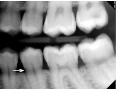 <p>T/F these are root caries </p>