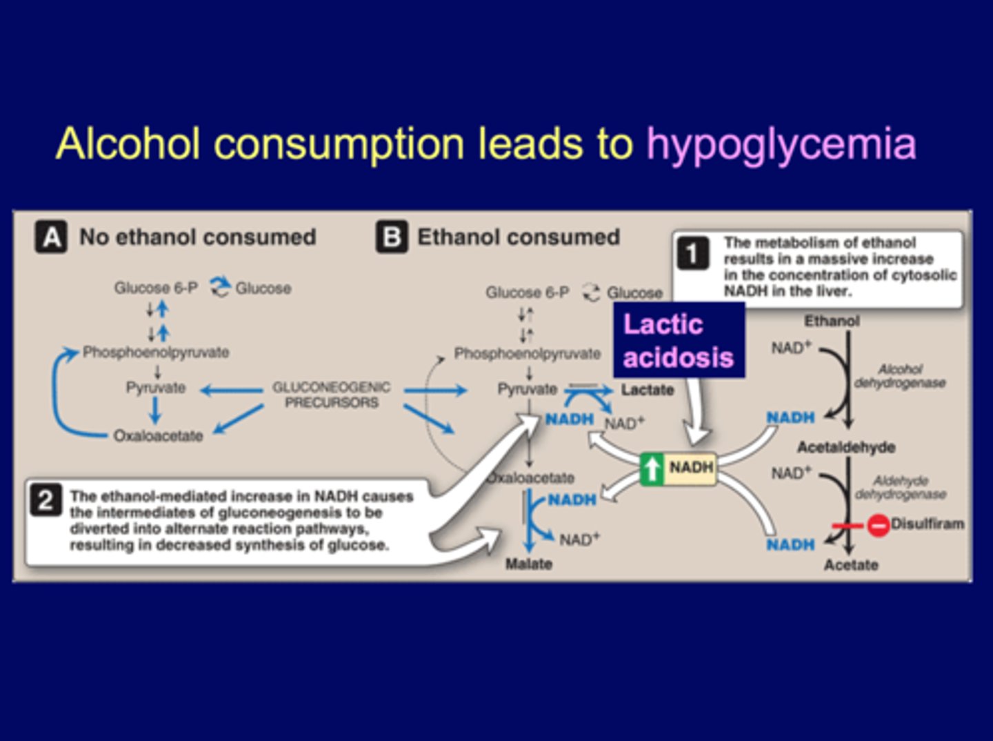 <p>The ethanol-mediated increase in NADH causes intermediates of gluconeogenesis to be diverted to alternate rxn pathways: </p><p>pyruvate to OAA-->malate (driven by NADH)</p><p>pyruvate to lactate <strong>(lactic acidosis)</strong></p><p><strong>decreases precursors for glucose </strong></p><p></p><p>-exhaust pyruvate and OAA (increase lactate and malate) </p><p>-HIGH levels of cytosolic NADH → Impaired gluconeogenesis (pyruvate convert to lactate, OAA convert to malate) →</p><p><strong>Hypoglycemia (decrease glucose)</strong> </p>