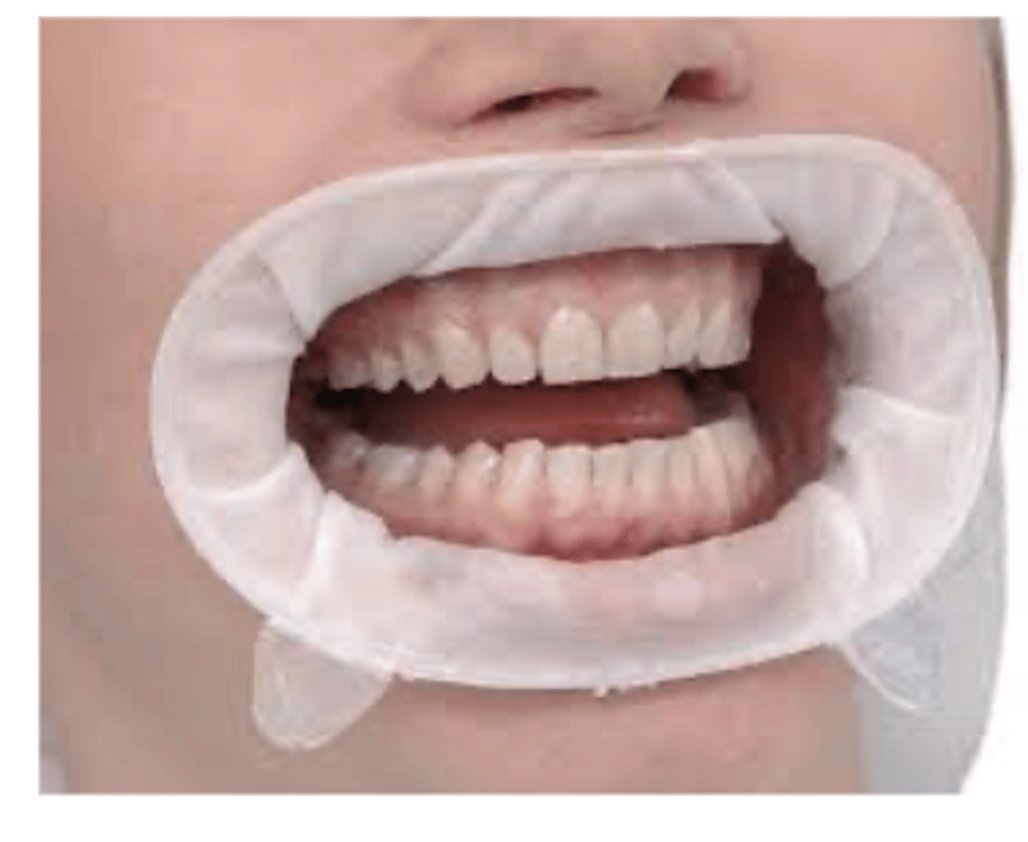 <p>retracts lips --> helpful for those with strong lips</p><p>anterior teeth</p><p>improves visibility</p>