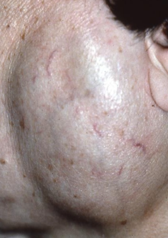 <p>What are possible treatment options for LESA?</p>
