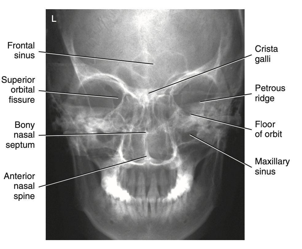 <p>What is <u>best demonstrated</u> for <strong>PA axial projection: Caldwell method </strong>for <strong>facial bone</strong>?</p>