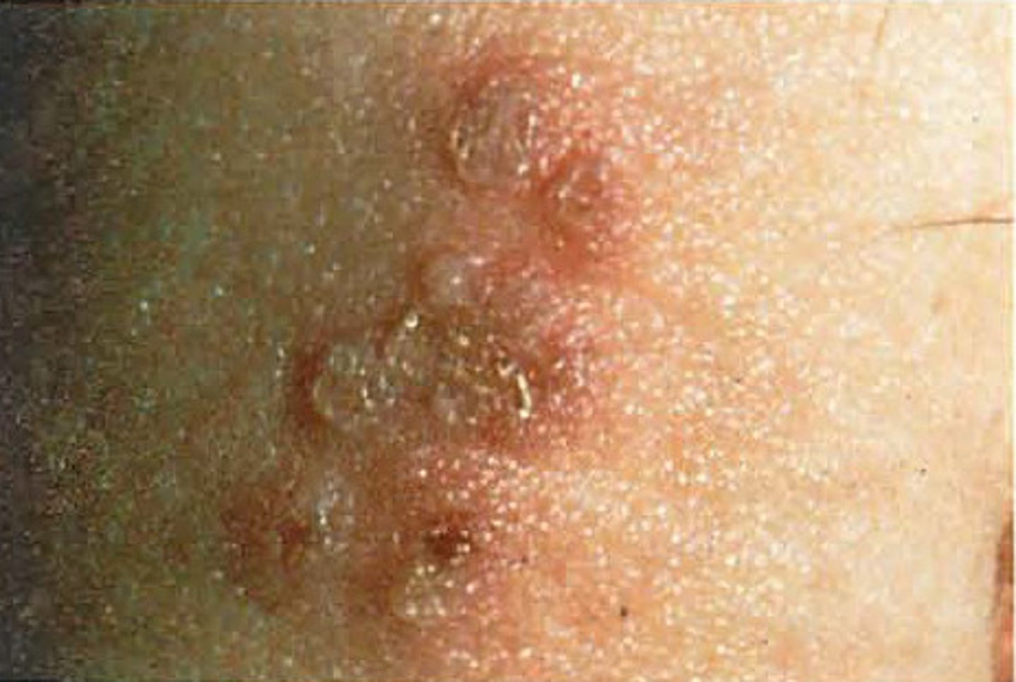 <p>Herpes simplex virus (usually type 2)</p>