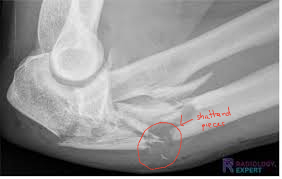 <ul><li><p>shattered pieces of bone</p></li><li><p>broken into 3 or more pieces </p></li><li><p>caused by high impact forces (i.e: car accidents)</p></li></ul><p></p>