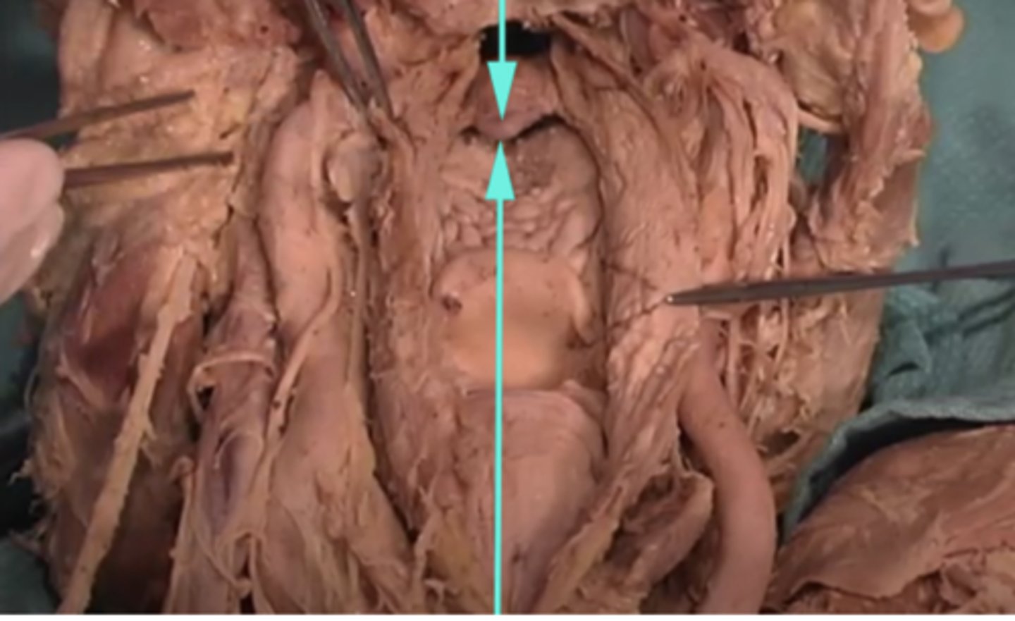 <p>What is the name of the structure as indicated by the arrow?</p><p>-soft palate</p><p>-brachiocephalic artery</p><p>-epiglottis</p><p>-uvula</p>