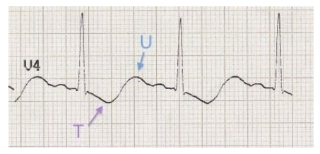 <p>What does this EKG show?</p>