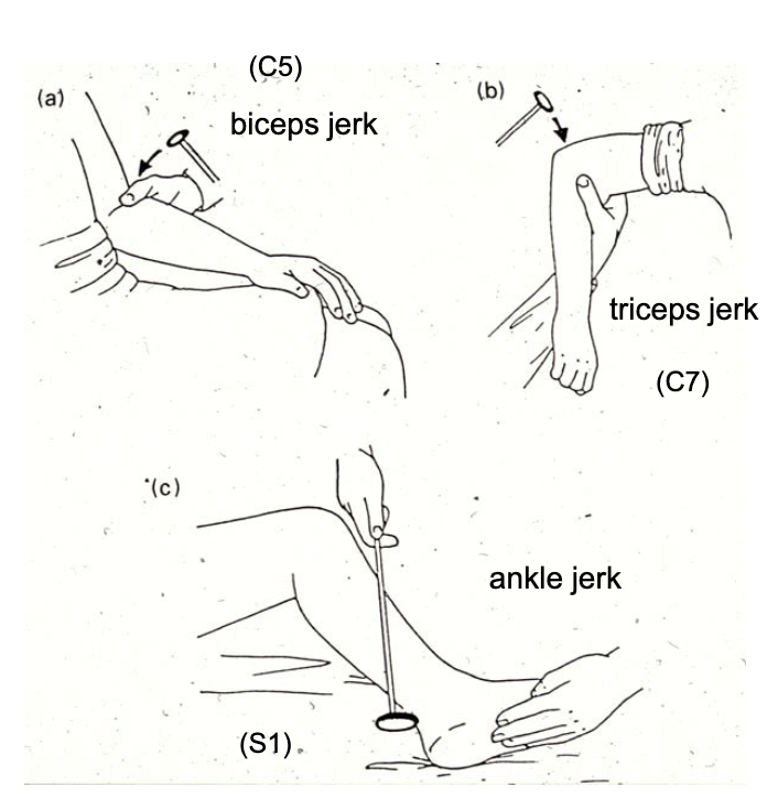 <p>exaggerated reflexes during deep tendon reflex testing is a sign of…?</p>