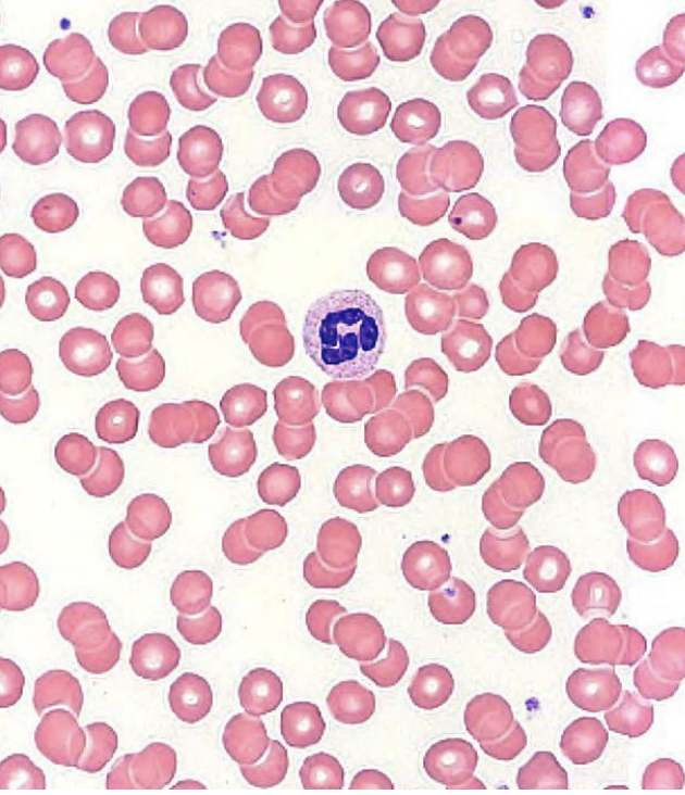 <p><strong>granular leukocytes: neutrophils</strong></p><ul><li><p>no strong dye attraction</p><ul><li><p>2-5+ lobed nuclei</p></li><li><p>polymorphonuclear leukocytes (polys)</p></li></ul></li><li><p>found in blood and tissues</p></li><li><p>life span: < 1 week</p></li><li><p>phagocytic and chemotaxic</p></li><li><p>degranulation</p><ul><li><p>____ and ____</p></li></ul></li><li><p>pus</p></li><li><p>~60% of WBCs (abundant)</p></li></ul><p></p>