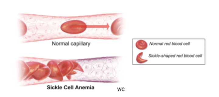 <p>Sickle cell disease </p><p>-<em>A </em>allele: normal hemoglobin and functional, round red blood cells </p><p><em>S</em> allele: Mutation induces hemoglobin aggregation, causing sickle cells, which causes chronic anemia. </p><p>-Sickle cell (<em>S </em>) allele causes mutations in hemoglobin but also confers malaria resistance. </p>