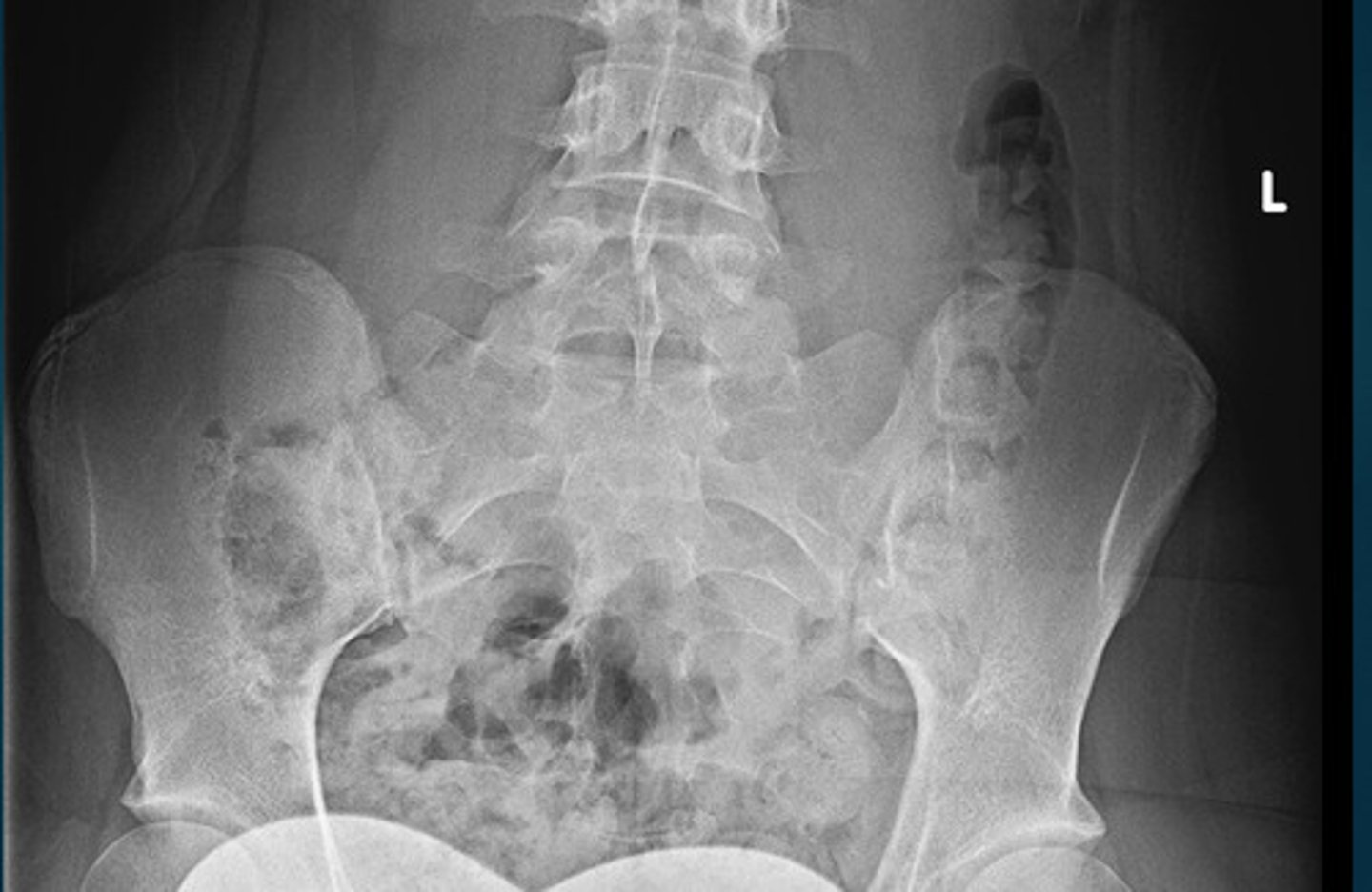 <p>What grade Risser sign is this?</p>