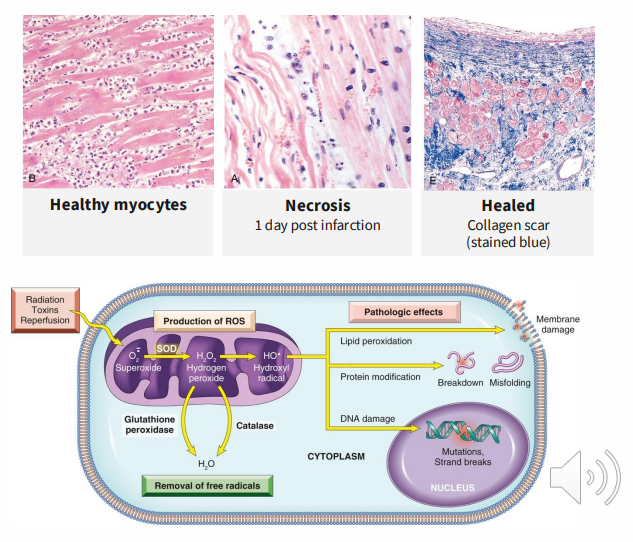 <p>MECHANISMS OF DAMAGE:</p><p>Ischaemia:</p><p>- waste not removed</p><p>- mitochondrial damage</p><p>- leaking of proteolytic enzymes</p><p>.</p><p>Ischaemia reperfusion injury:</p><p>Oxygen restoration:</p><p>- more free radicals, reactive oxygen species -&gt; damage</p><p>- Calcium overloading -&gt; arrhythmias, apoptosis</p><p>- Exaggerates inflammation</p>