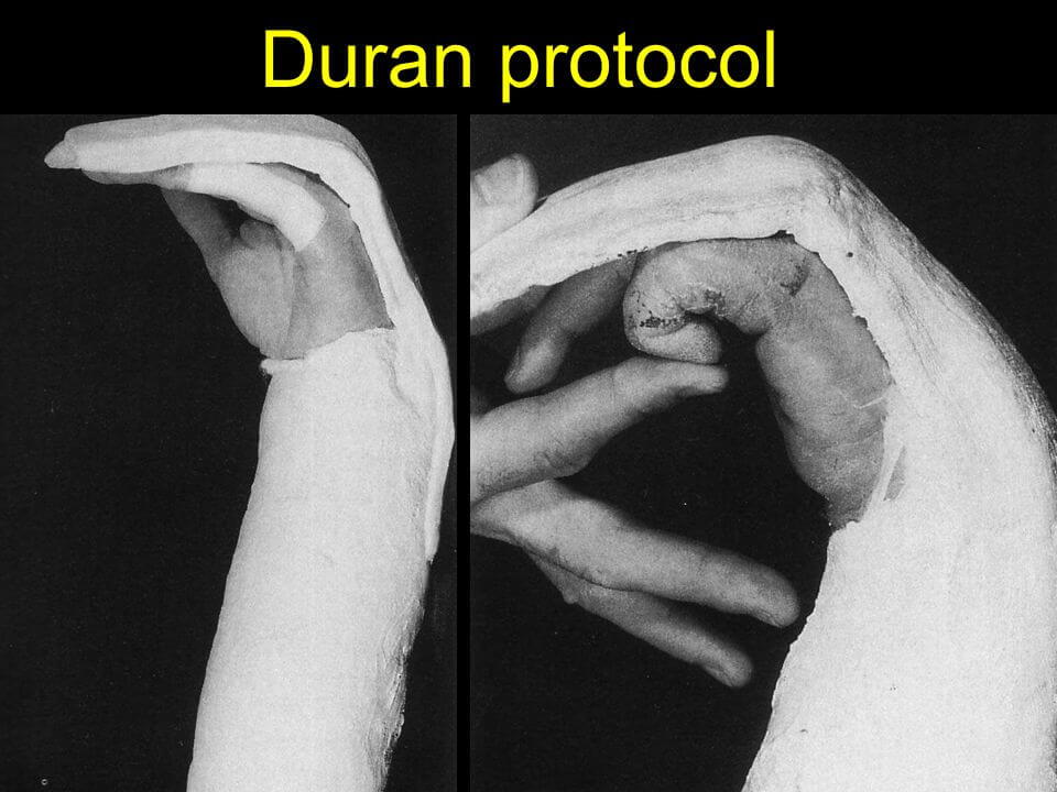 <p>For flexor tendon repair</p><p>~”Do it yourself” protocol- where client uses static splint and provides own passive flexion (self-range of motion for flexion)</p><p>0-4wk (dorsal block splint, passive flex of PIP/DIP. ten reps per hour<br>4-6wk: active flex/ext<br>6-8wk:tendon gliding, scar management</p>
