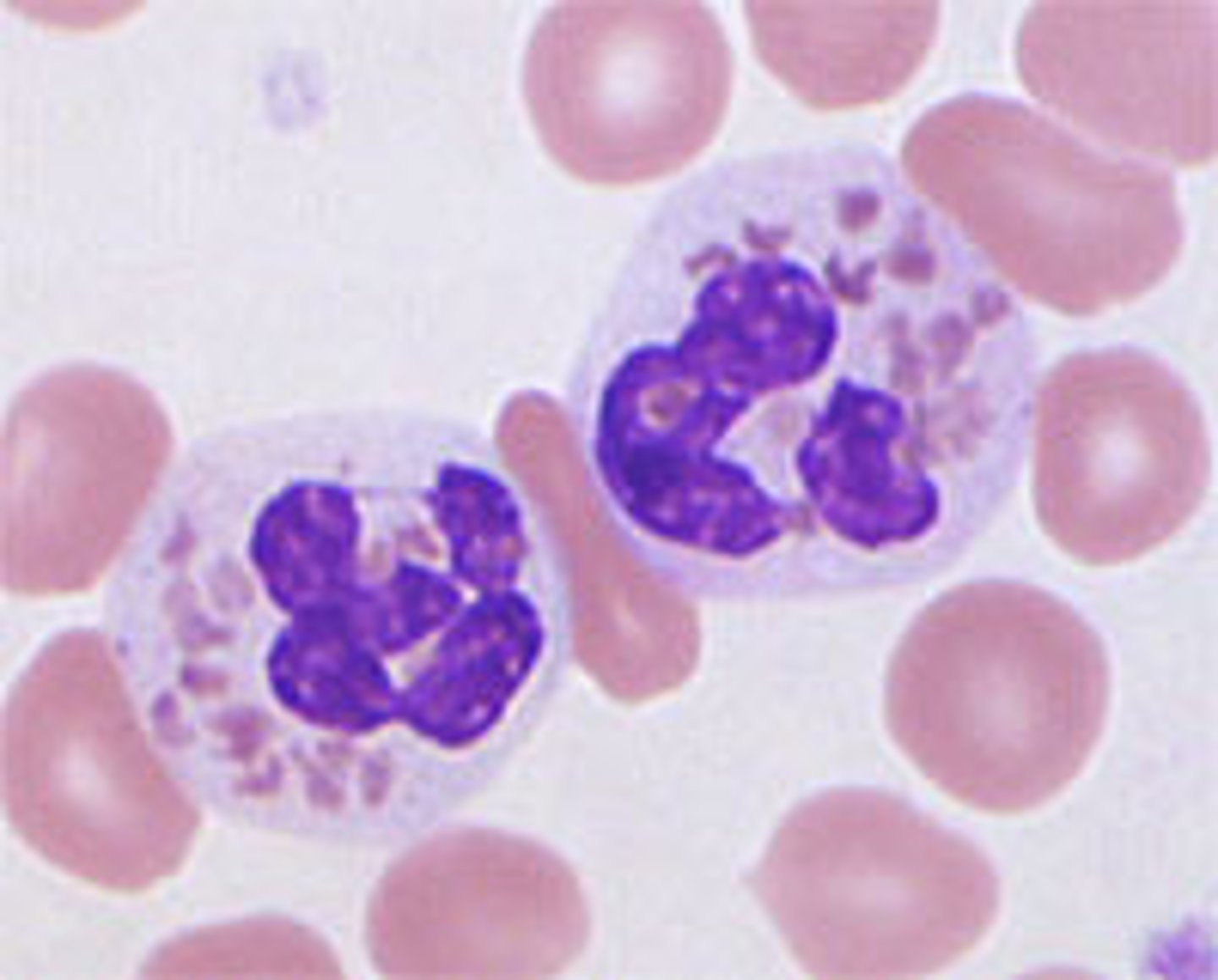 <p>Rare, recessive disorder<br>-neutropenia, thrombocytopenia<br>-albinism<br>-fusion of neutrophil primary and secondary granules, issues with chemotaxis</p>