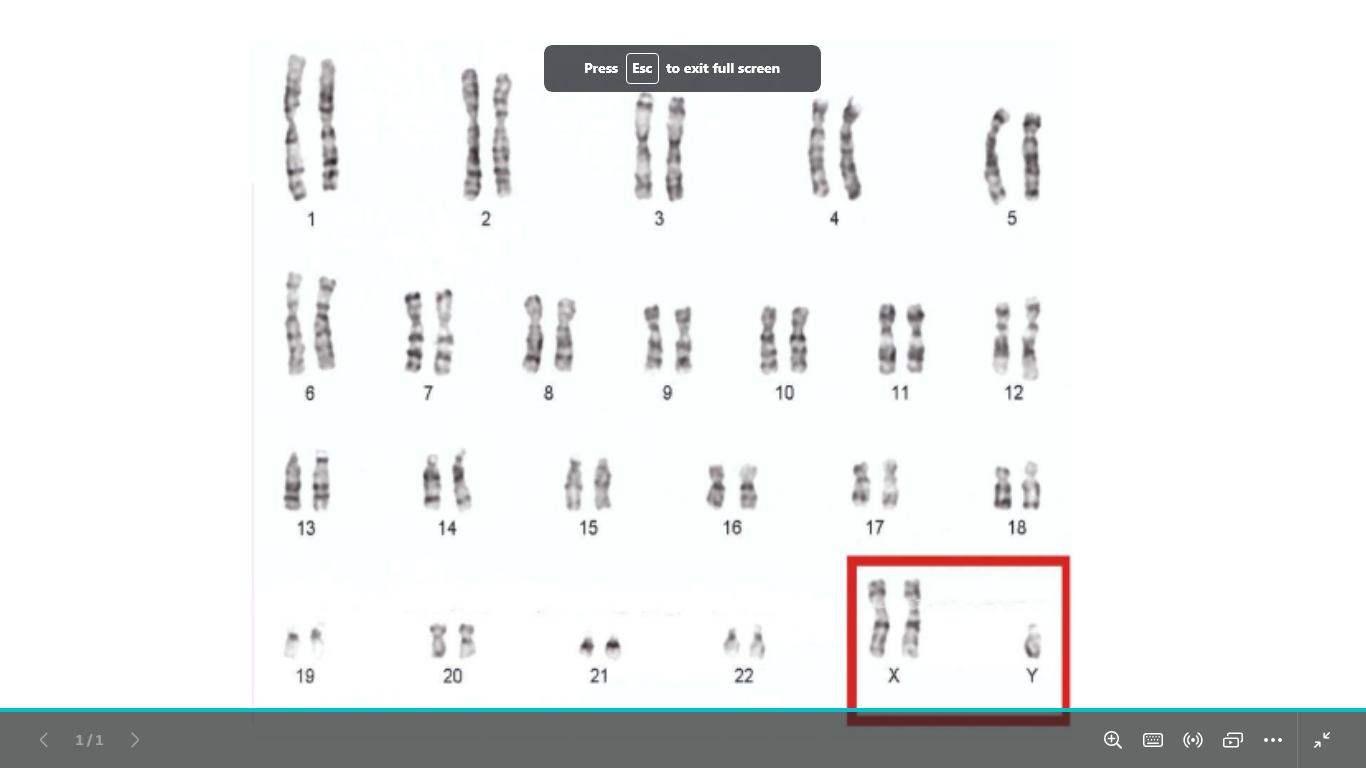 <p>type of chromosomal abnormality</p><p>gender </p><p>syndrome name </p><p>karyotype</p><p>caused by ?</p><p>common ?</p>