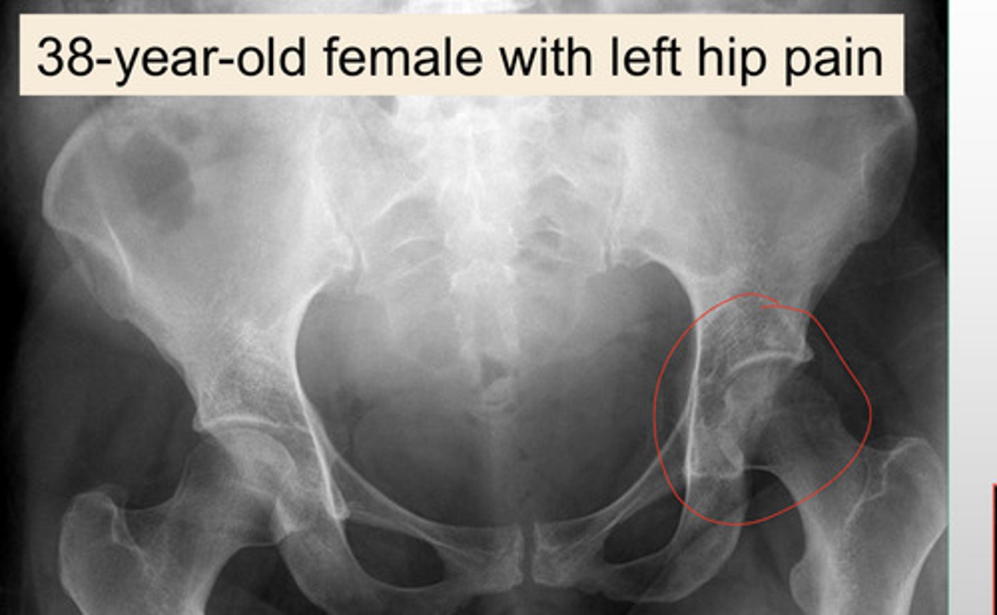 <p>What cause a radiolucent femur head/hip region on the left?</p>